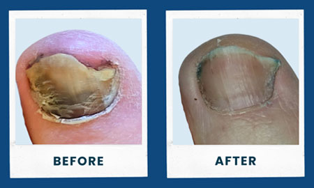 toefx before and after
